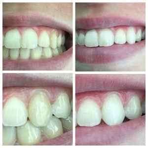 Internal Bleaching