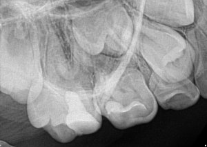 Vital Pulp Therapy FDG Endo