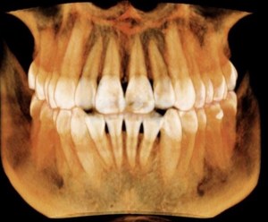Cone Beam 3D Image  of teeth